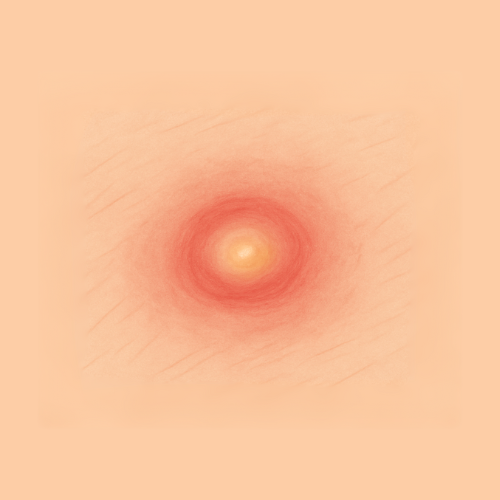 Image dessinée d'un furoncle