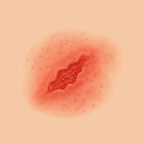 Image dessinée d'une plaie