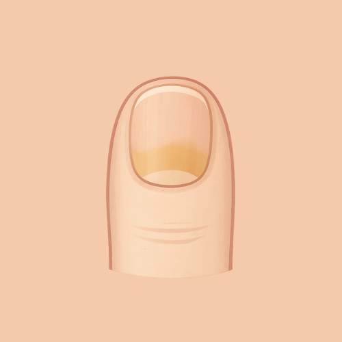 Image dessinée d'une mycose de l'ongle