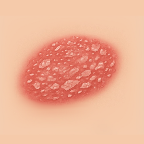 Image dessinée d'un psoriasis