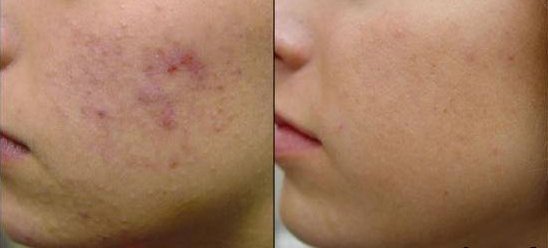 EMUAID Traitement de nuit contre l'acné 1oz