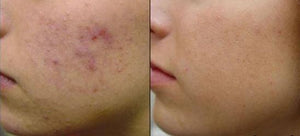 EMUAID Acne Erasing Duo