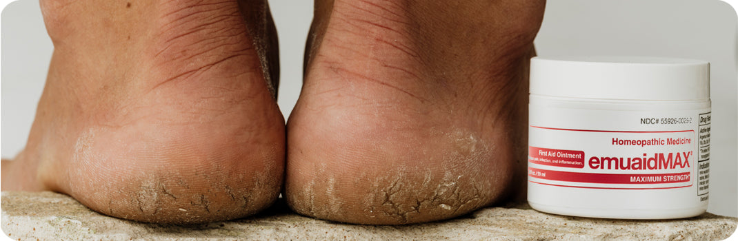 EMUAID les agents pathogènes et supprime les verrues plantaires et palmaires sans gel ni brûlure*.