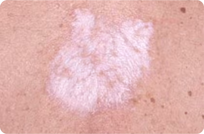 Souffrez-vous de lichen sclérosé ?
