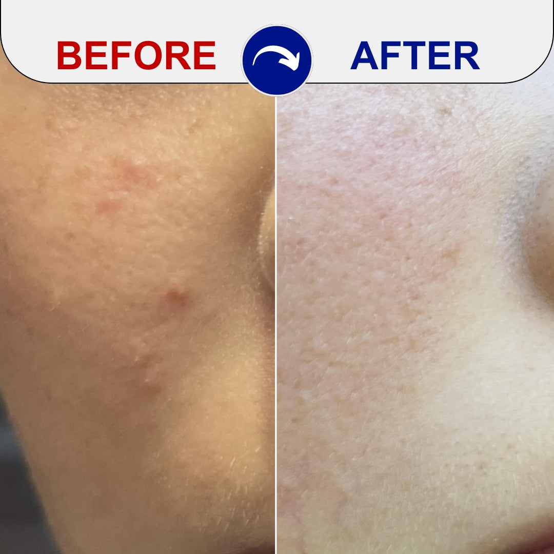 comparaison du traitement de l'acné avant et après