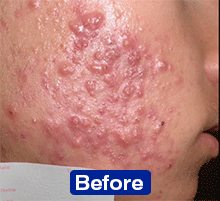 Résultats d'études cliniques