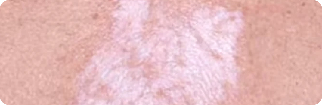 Souffrez-vous de lichen sclérosé ?
